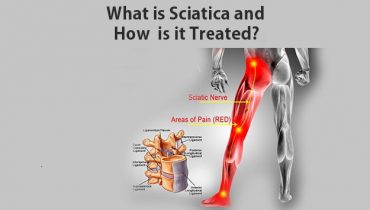 sciatica-pain-treatment
